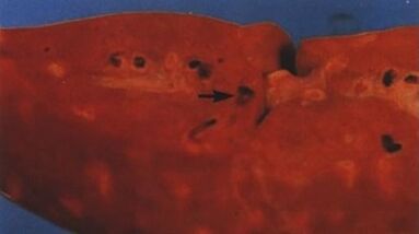 Какие паразиты могут жить в сердце человека